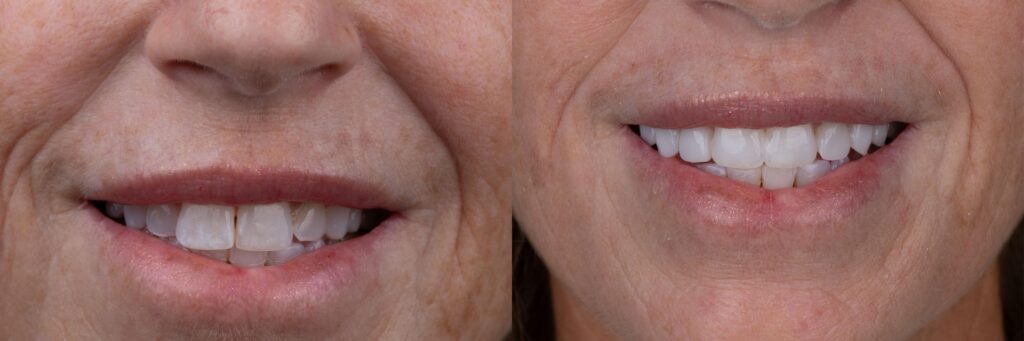 Smile on Westbury | Dental Bonding