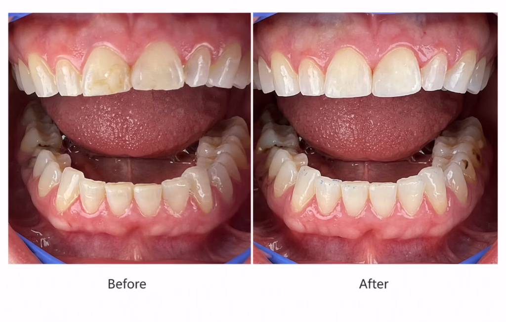 composite bonding - no veneers - before and after