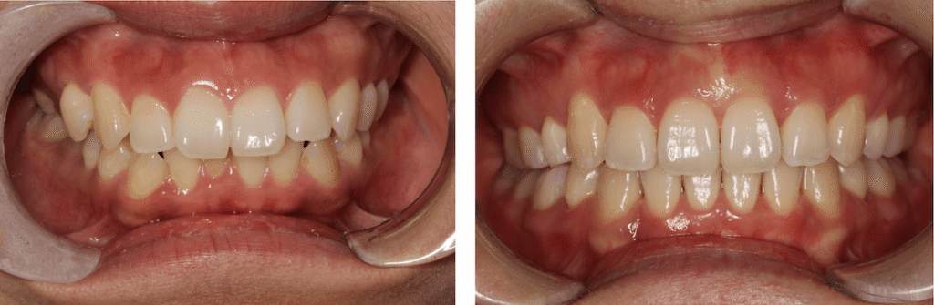 Smile on Westbury | Invisalign