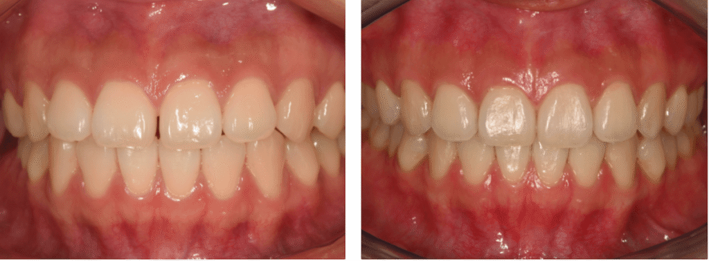 Smile on Westbury | Invisalign