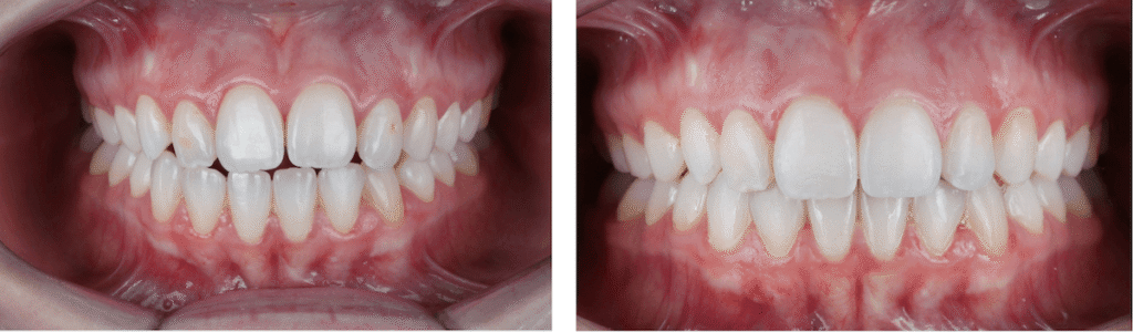 Smile on Westbury | Invisalign