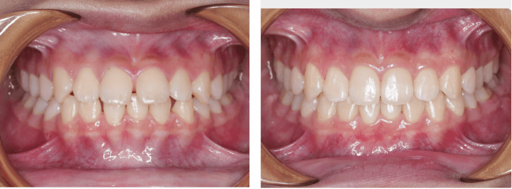 Smile on Westbury | Invisalign