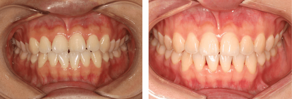 Smile on Westbury | Invisalign