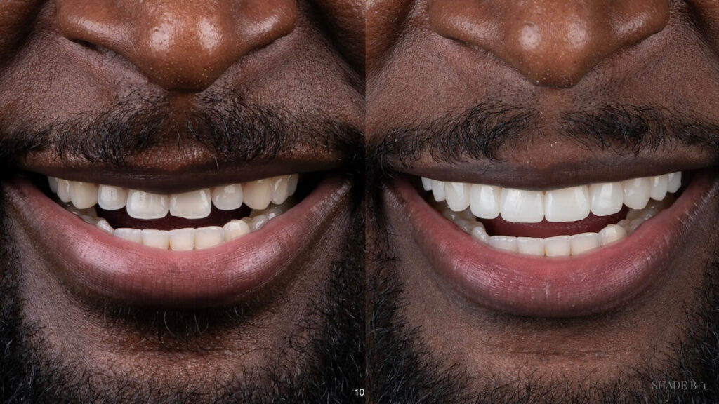 Smile on Westbury | Dental Bonding