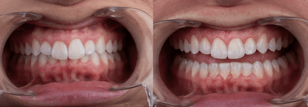 Smile on Westbury | Dental Bonding