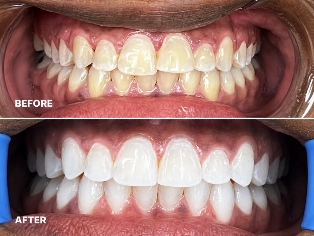Smile on Westbury | Invisalign