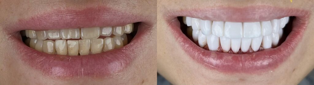 Smile on Westbury | Invisalign