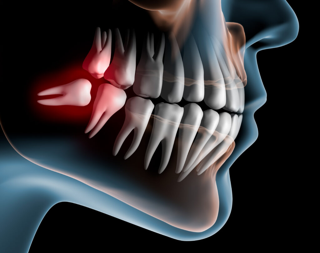 Wisdom Tooth Pain in Westbury, NY: When Oral Surgery May Help