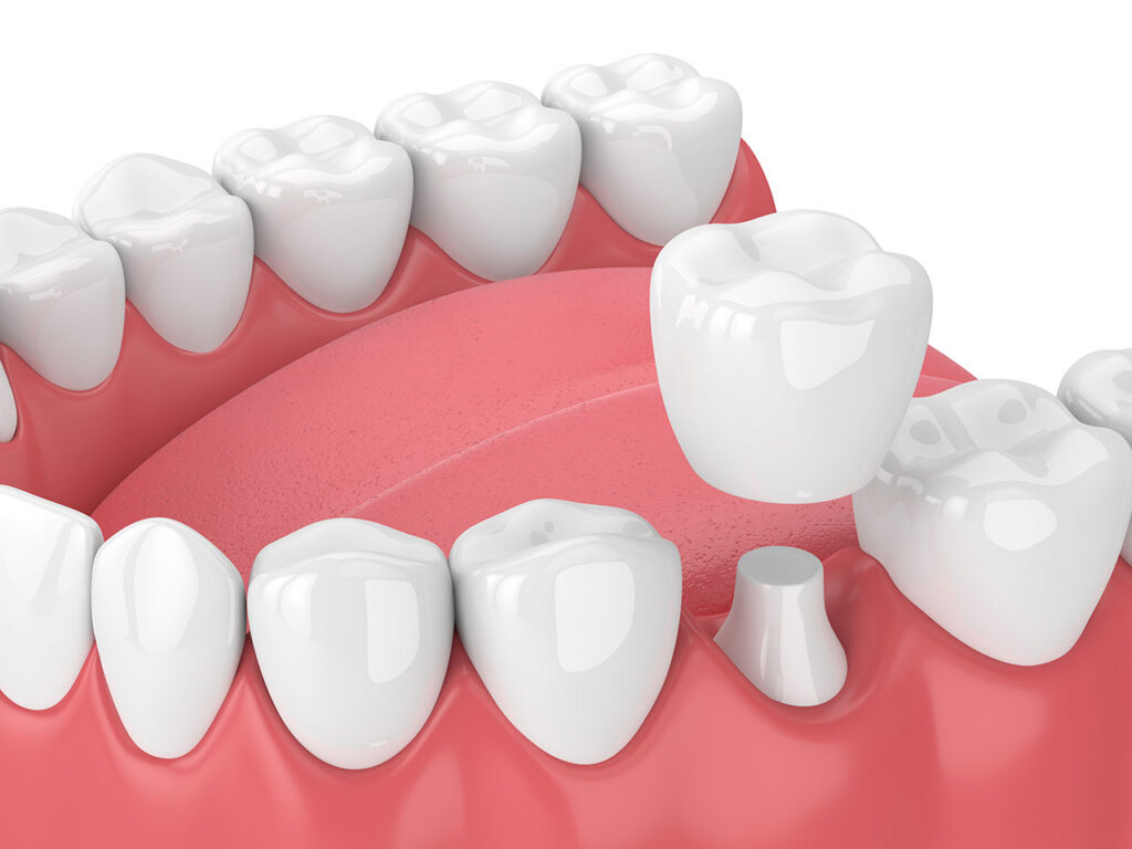 Dental Crowns for Cracked Teeth in Westbury: When Does a Tooth Need Protection?
